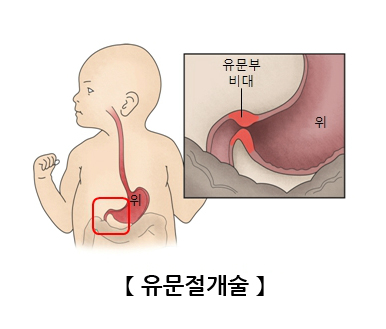 유문절개술